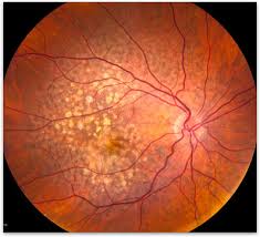 Age-Related Macular Degeneration Market - Copy