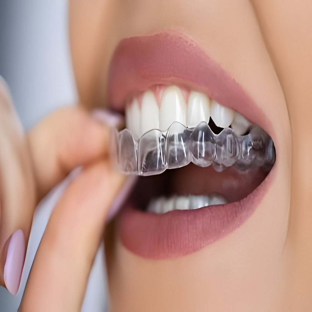 Aligners in Abu Dhabi Straighten Your Teeth Discreetly