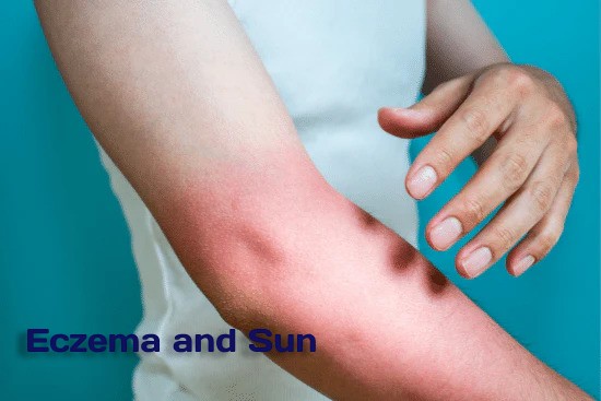 eczema sun exposure