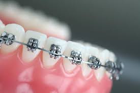 Global Orthodontics Market