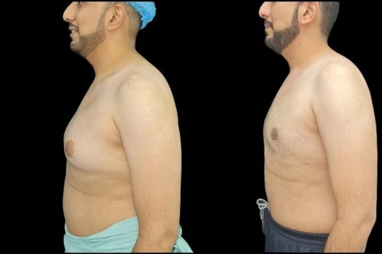 Gynecomastia6