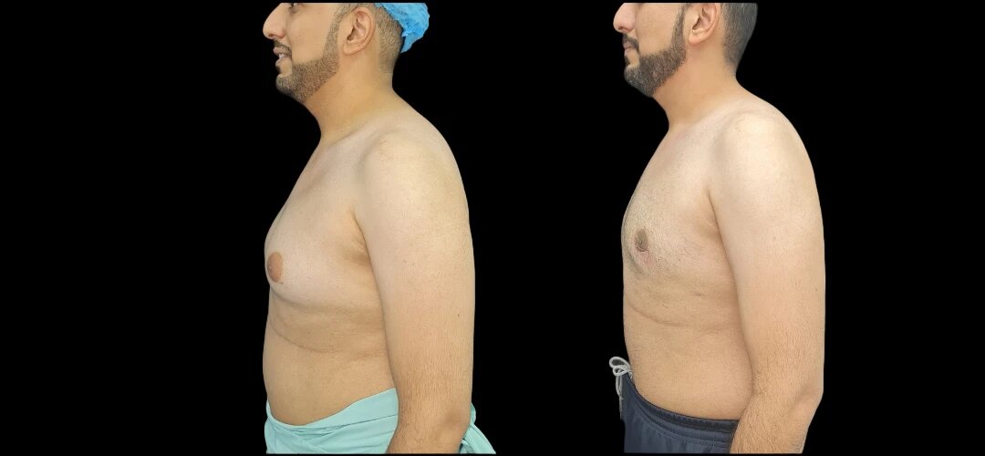 Gynecomastia6