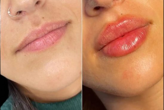 H2-lip-fillers