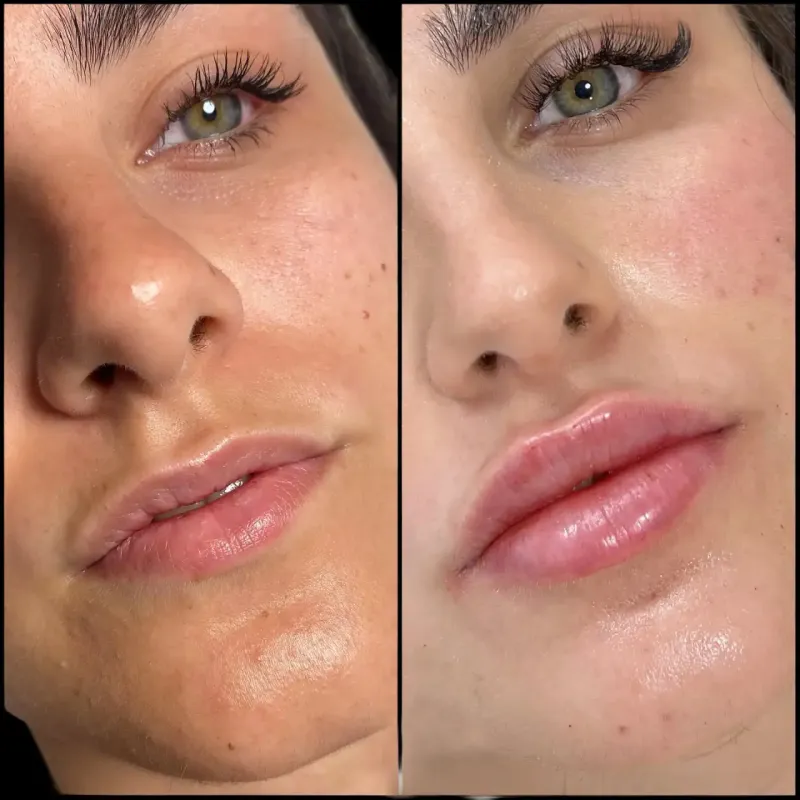 Juvederm