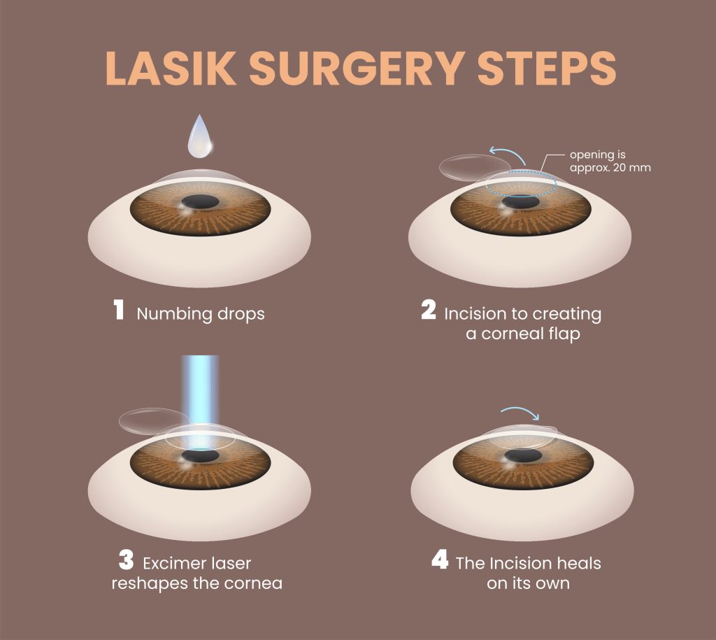 Laser eye surgery Brisbane