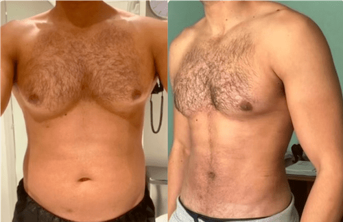 NPS_funderburk-before-after-male-hd-lipo-2.16-5-min