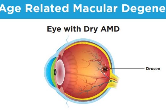 macular-degeneration