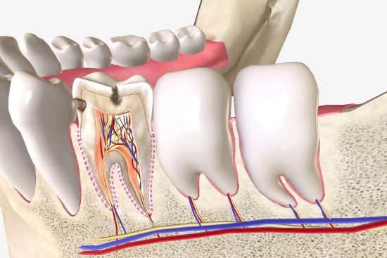 root canal treamtment  uu857