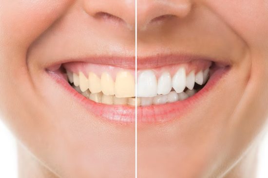 teeth whitening price in Lahore, Pakistan