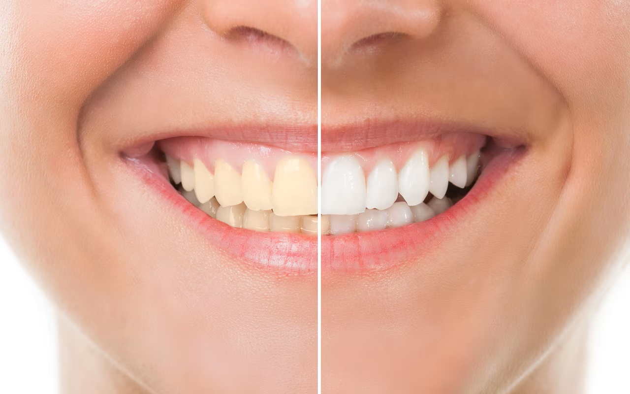 teeth whitening price in Lahore, Pakistan