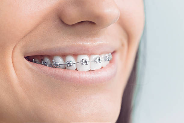 Disadvantages of Ceramic Braces vs. Metal Braces