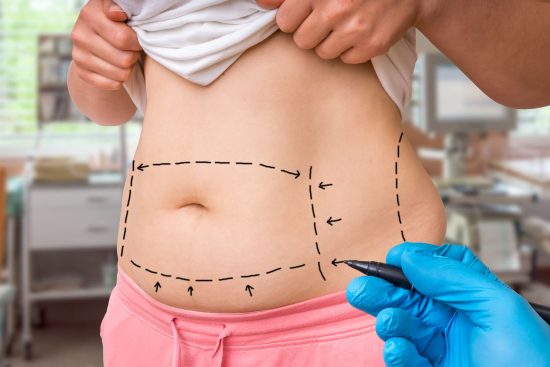 Liposuction surgery in Dubai (17)