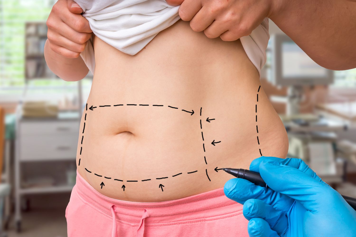 Liposuction surgery in Dubai (17)