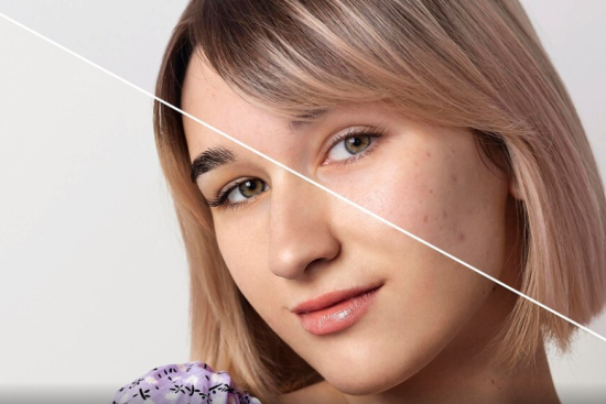 Melasma Treatment East Ham