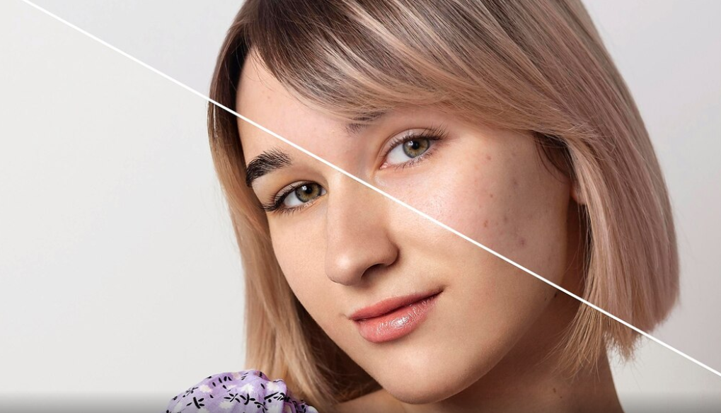 Melasma Treatment East Ham